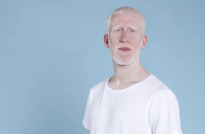 Sancionada lei que cria política de proteção a pessoas com albinismo