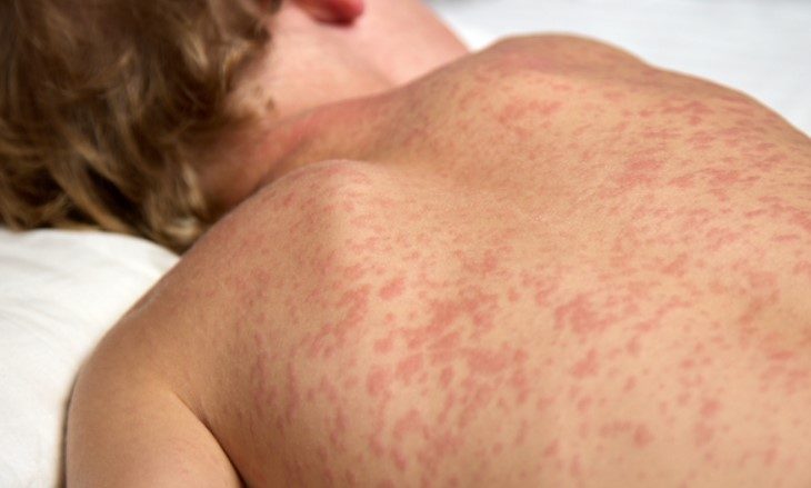 Busca ativa por casos de sarampo é intensificada em MS com apoio do Ministério da Saúde