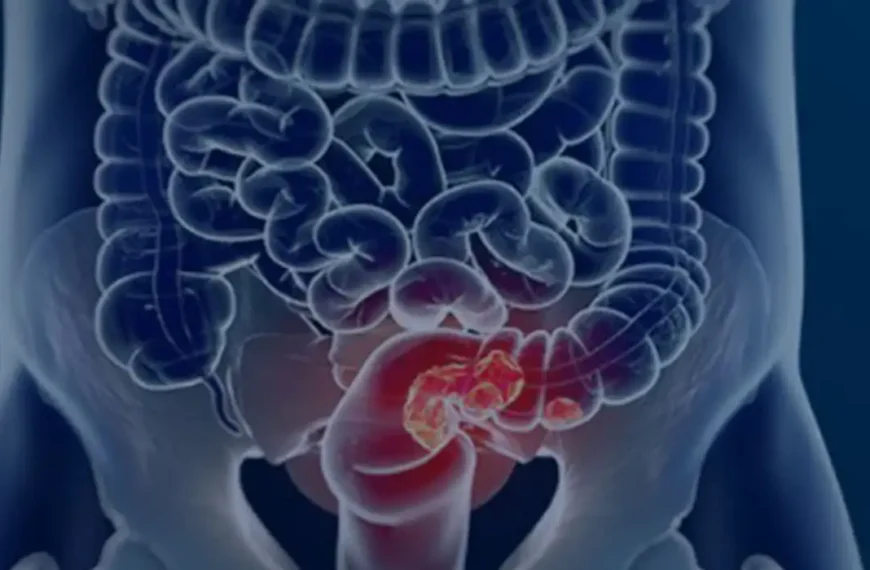 Estudo projeta aumento de 36% em mortes por câncer colorretal até 2040